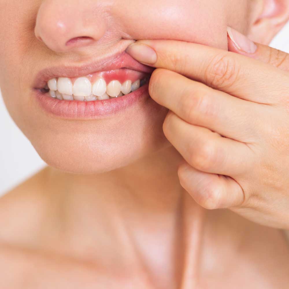 Periodontal-Disease