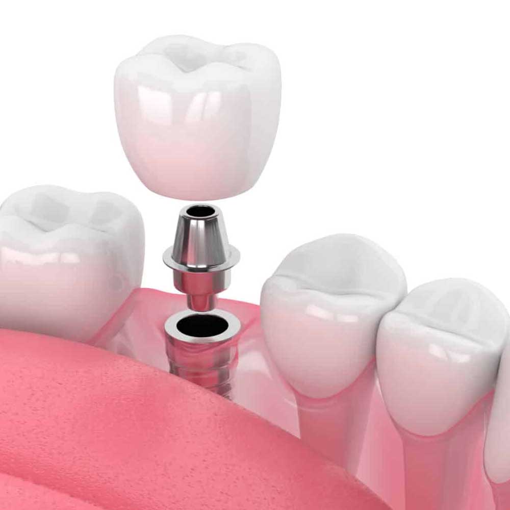 dental-implant