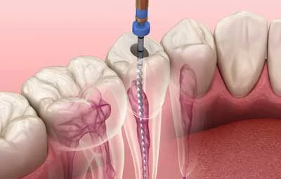 Root Canal Therapy