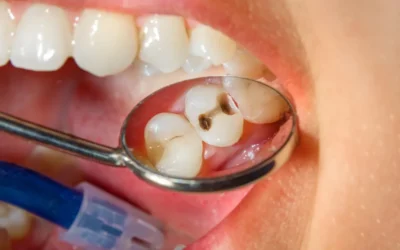 Signs Your Dental Filling Needs to Be Replaced
