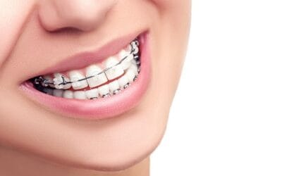 Common Questions About Dental Braces