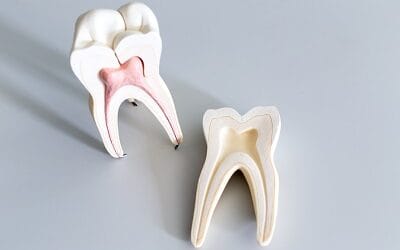 Reasons for Root Canal Therapy