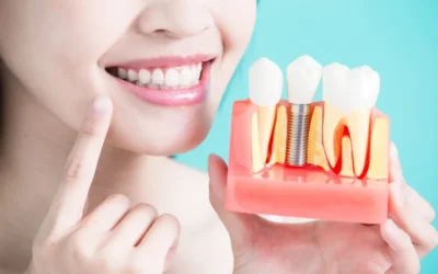 What to Expect With Dental Implants