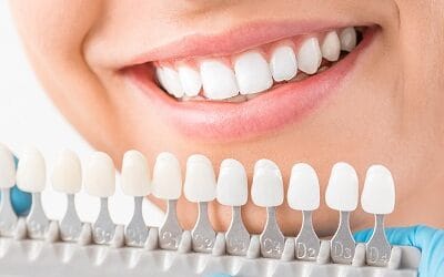 The Difference Between Traditional and No-Prep Veneers