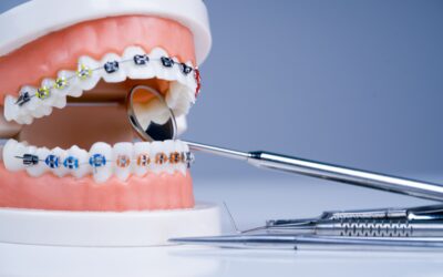 Implant-Supported Dentures Vs Traditional Dentures – Which One Is Right for You?