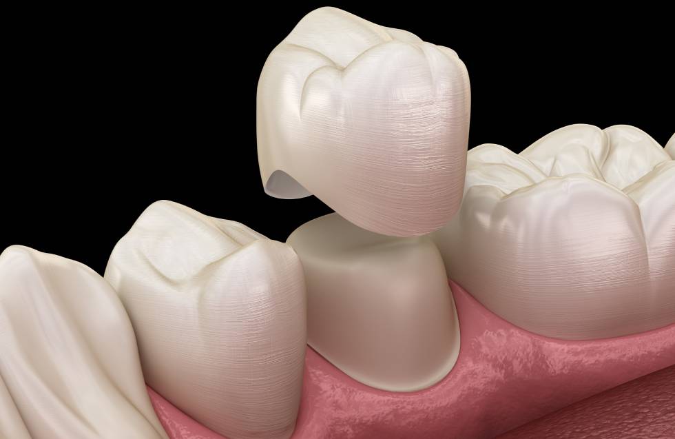 3D illustration of Dental crown premolar tooth assembly process.