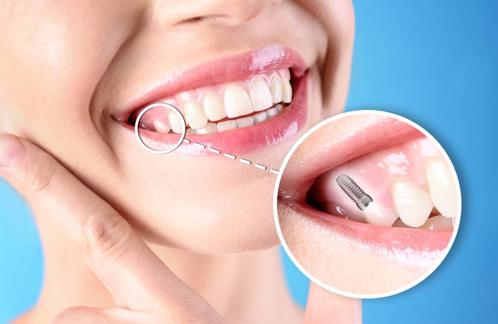 Woman with beautiful smile after dental implant installation procedure