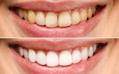 How Vaping Affects Tooth Enamel After Cosmetic Dental Treatments?